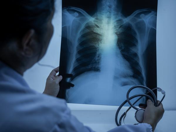 A Phase II Study of SSGJ-707 Monotherapy in First-line PD-L1 Positive  Advanced NSCLC Patients | TrialScreen